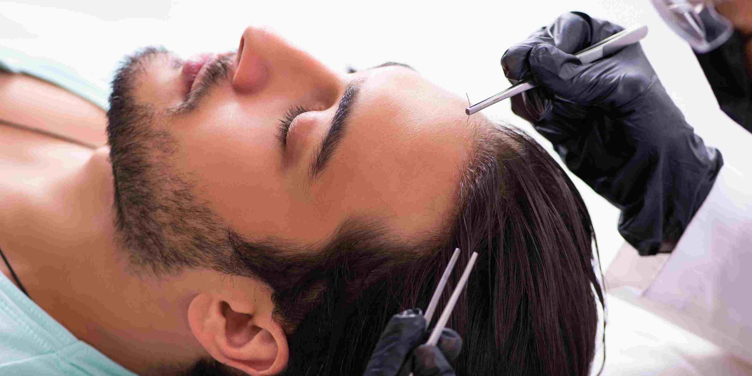 Come rimanere comodo e calmo durante la tua procedura di trapianto di capelli