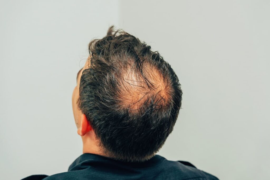 Diagnosis and Measurement of our Baldness