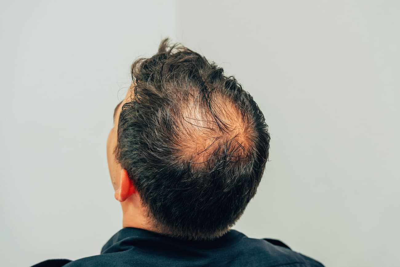 Norwood-Hamilton Scale: Diagnosis and Measurement of our Baldness