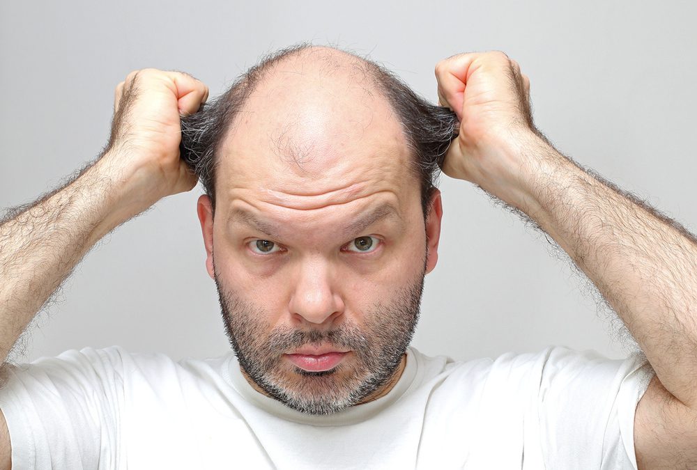 Psychogenic Alopecia: how to distinguish it from Androgenetic Alopecia and supporting treatments